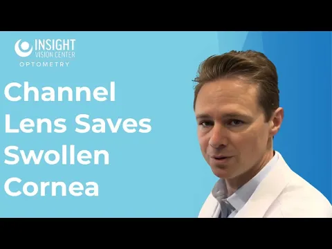 How Four Channels in Scleral Lenses Fix Swollen Corneas After Transplants