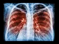 CPT code for Pulmonary imaging - simplify medical coding