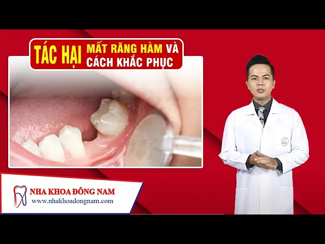 Outline Video Tác Hại Của Việc Mất Răng Hàm Và Cách Khắc Phục | NHA KHOA ĐÔNG NAM®