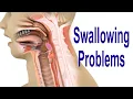 Swallowing Problems or Dysphagia Top 4 Possible Causes Including Cricopharyngeal Dysfunction CPD