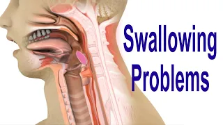 Swallowing Problems or Dysphagia Top 4 Possible Causes Including Cricopharyngeal Dysfunction CPD