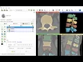 Semi-automatic vertebra segmentation on CT