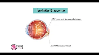  ต้อหินเป็นโรคที่เกิดจากอะไร และมีอาการอย่างไรบ้าง 