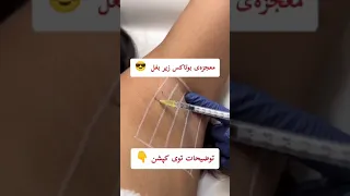 بوتاکس زیر بغل راز عرق نکردن سلبریتی ها  بوتاکس زیر بغل راز عرق نکردن سلبریتی ها