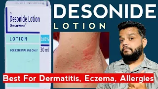 Desinide Lotion Review | Eczema, Dermatitis, Fungal Infection