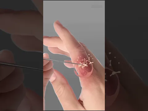 Never pop the blisters