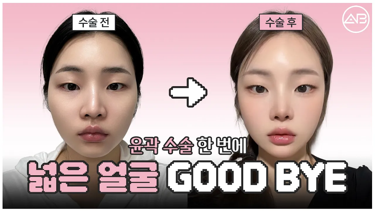 윤곽수술 회복기간 솔직 후기✨ 식사, 붓기, 실밥 제거까지 | 에이비성형외과