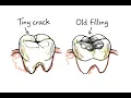 Dental Crowns Why Waiting Can Cost You Your Tooth Renton WA Dentist Explains