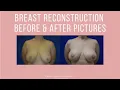 Breast Reconstruction Before After Pictures Photo Gallery