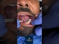 Teeth Cleaning The Sparkling Transformation Dental Short