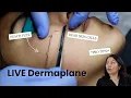 LIVE DERMAPLANE Q A WITH MASTER AESTHETICIAN