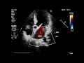 Asvide Color Doppler flow imaging in apical five-chamber view shows accelerated blood flow