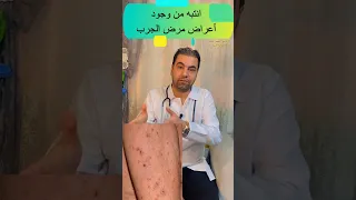 احذر من وجود أعراض مرض الجرب  احذر من وجود أعراض مرض الجرب