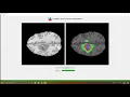 Brain Tumor Segmentation via BU-Net GUI Front-End