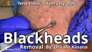 The Best Blackhead Removal video by Dr.Lalit Kasana / New Blackhead Removal Video 3 February 2026