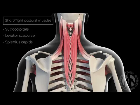 Forward Head Posture