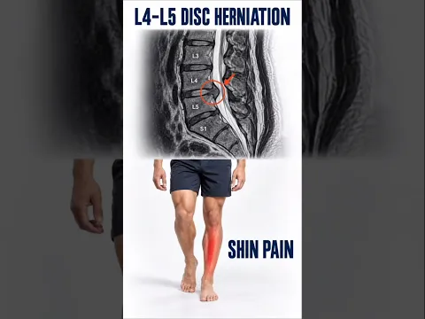 L4–L5 Disc Herniation Causing Shin Pain? Try This Rehab #L4-L5