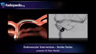 Stroke: Endovascular management of ischaemic stroke - radiology video tutorial
