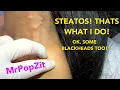 Steatocystomas,blackheads,cysts,just under 30 minutes of pop! CHECK OUT MY NEW PRODUCTS!Link below!