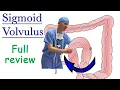 Sigmoid Volvulus Full Review
