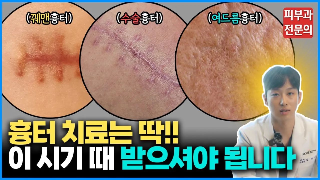 여드름 흉터, 켈로이드 흉터 각종 흉터의 골든타임과 치료시기 알려드립니다~