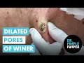Two HUGE Dilated Pores of Winer