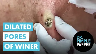 Two HUGE Dilated Pores of Winer