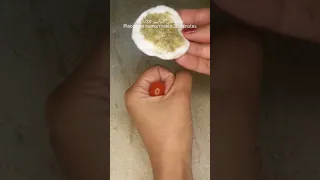 علاج سهل للبواسير بدون جراحة Hemorrhoids Shorts 