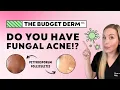 5 Signs You Have Fungal Acne NOT Regular Acne The Budget Derm Explains