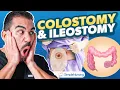 Short Colostomy Ileostomy