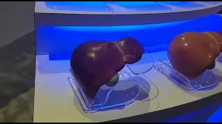 FÍGADO LIMPO X FÍGADO SUJO Graus de Gordura e sujeiras.