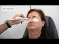 Dry Eye IPL Treatment Available at George Matilda Eyecare