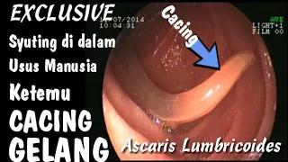 Download Penampakan Cacing Di Dalam Tubuh Manusia - Cara rekam saluran cerna ada Link di Deskripsi MP3