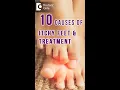 10 Causes of ITCHY FEET how to get relief - Dr Urmila Nischal Doctors Circle