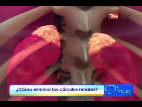 ¿Cómo eliminar los cálculos renales?