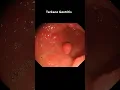 Download Lagu Ini yang terjadi pada lambung saat kita makan makanan pedas #gastritis #asamlambung #makananpedas
