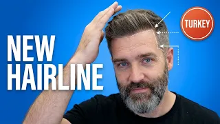 6 Months After My Hair Transplant in Turkey