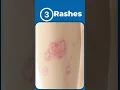 Download Lagu 5 Signs of Autoimmune Disease #rheumatoidarthritis #lupus #psoriaticarthritis #autoimmunedisease