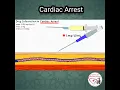 Download Lagu ADRENALINE (Epinephrine) DOSE in CARDIAC ARREST #pediatrics #medicine #epinephrine