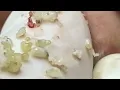 Extreme Blackhead Removal Deep Pore Cleaning Satisfying Extraction