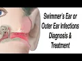 Outer Ear Infections aka Swimmer s Ear Infections Acute Otitis Externa Diagnosis and Treatment