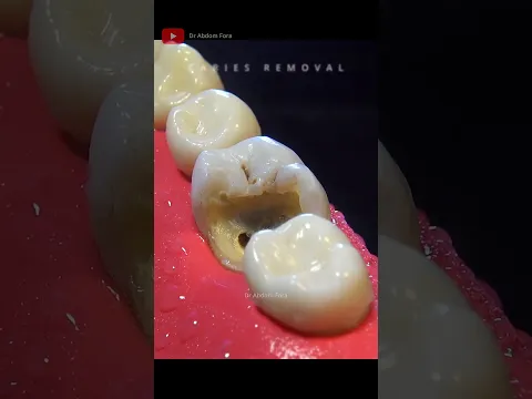 AMAZING Root Canal Treatment and Overlay  #satisfying #dentist