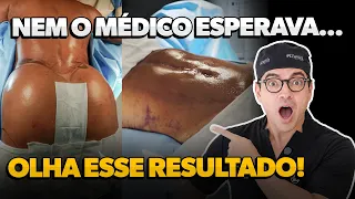 Veio do Interior pelo Glúteo dos Sonhos aos 60 Anos — e o Cirurgião Revelou algo Inesperado no Pós!
