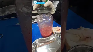 Butt Augmentation Using Fat Grafting And Result Brazilian Butt Lift In Delhi Shortfeed Shorts 