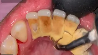 Teeth Scaling Calculus Removal 