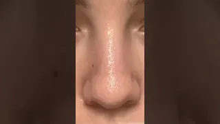 إزالة الرؤوس السوداء من الأنف طريقة سهلة 