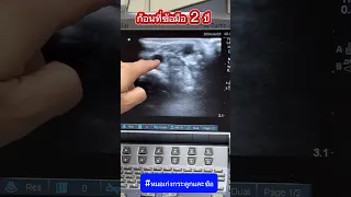  ถุงน้ำในข้อเกิดจากอะไรบ้าง 