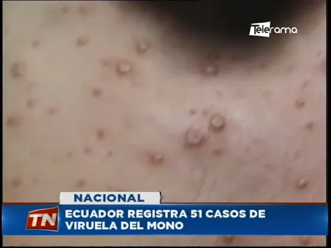 Ecuador registra 51 casos de viruela del mono