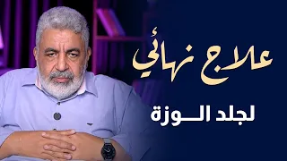 علاج نهائي لجلد الوزة لو عندك جلد الوزة يبقا الحل في الفيديو ده دكتور احمد الدملاوي جلد الوزة 