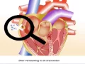 Angina pectoris - Symptomen en behandeling bij pijn op de borst
